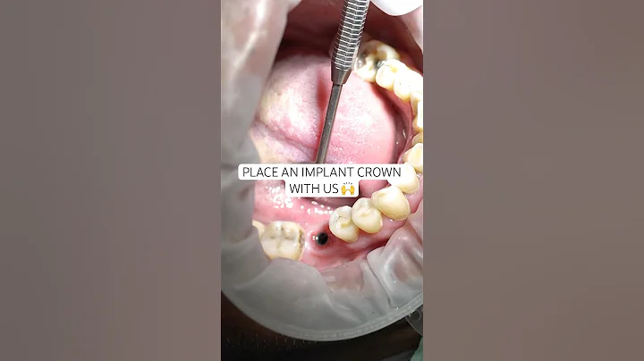 How it’s done: Placing an implant crown 🙌 #newsmile #dentalimplant #implant #compositeveneer