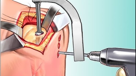 Left Humeral Intramedullary Nailing
