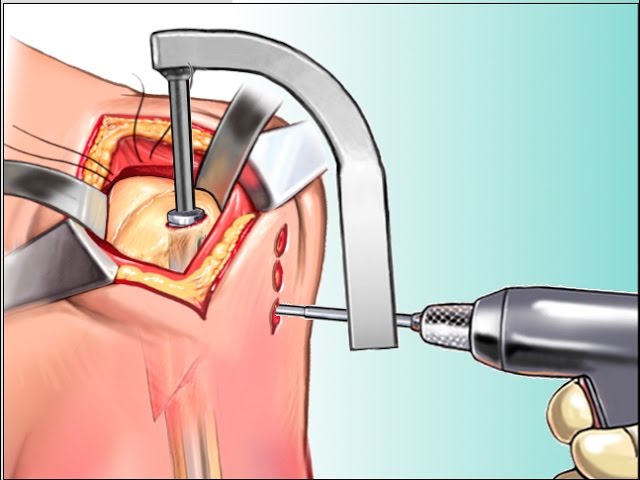 Surgical procedure for humeral IMIL nailing. | Download Scientific Diagram