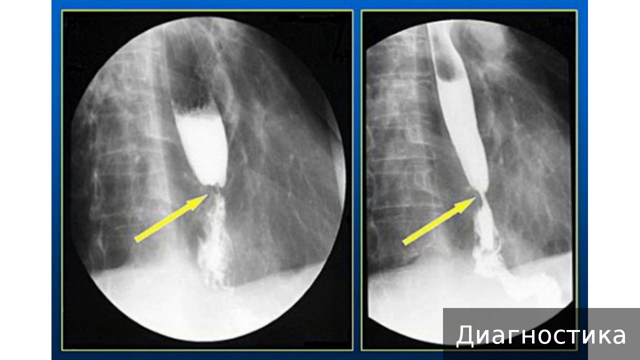 Н з пищевода. Пептическая язва пищевода рентген. Контрастирование пищевода барием. Непроходимость пищевода рентген. Пептическая стриктура пищевода.