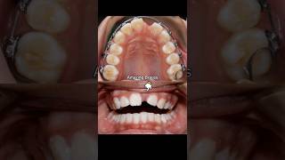 Braces challenge: Pulling down an impacted front tooth #braces #orthodontist #teeth #orthodontics
