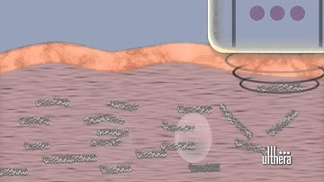 Ulthera Collagen Mechanism of Action Video