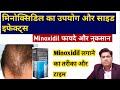 Minoxidil 2℅ 5℅ Dose and Uses INDIA | Minoxidil Ke Fayde aur Nuksan |मिनाक्सीडिल उपयोग साइड इफेक्ट्स