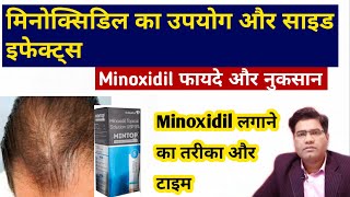 Minoxidil 2℅ 5℅ Dose and Uses in INDIA | (Fayde aur Nuksan)