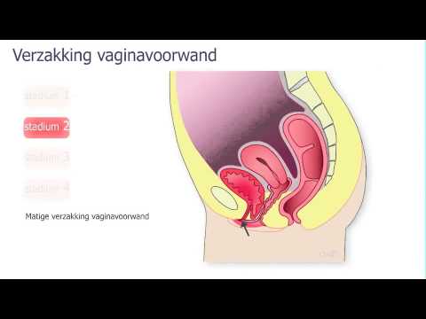 verzakking voorwand vagina