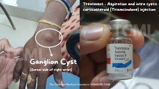 Ganglion cyst on dorsal side of wrist | TCML