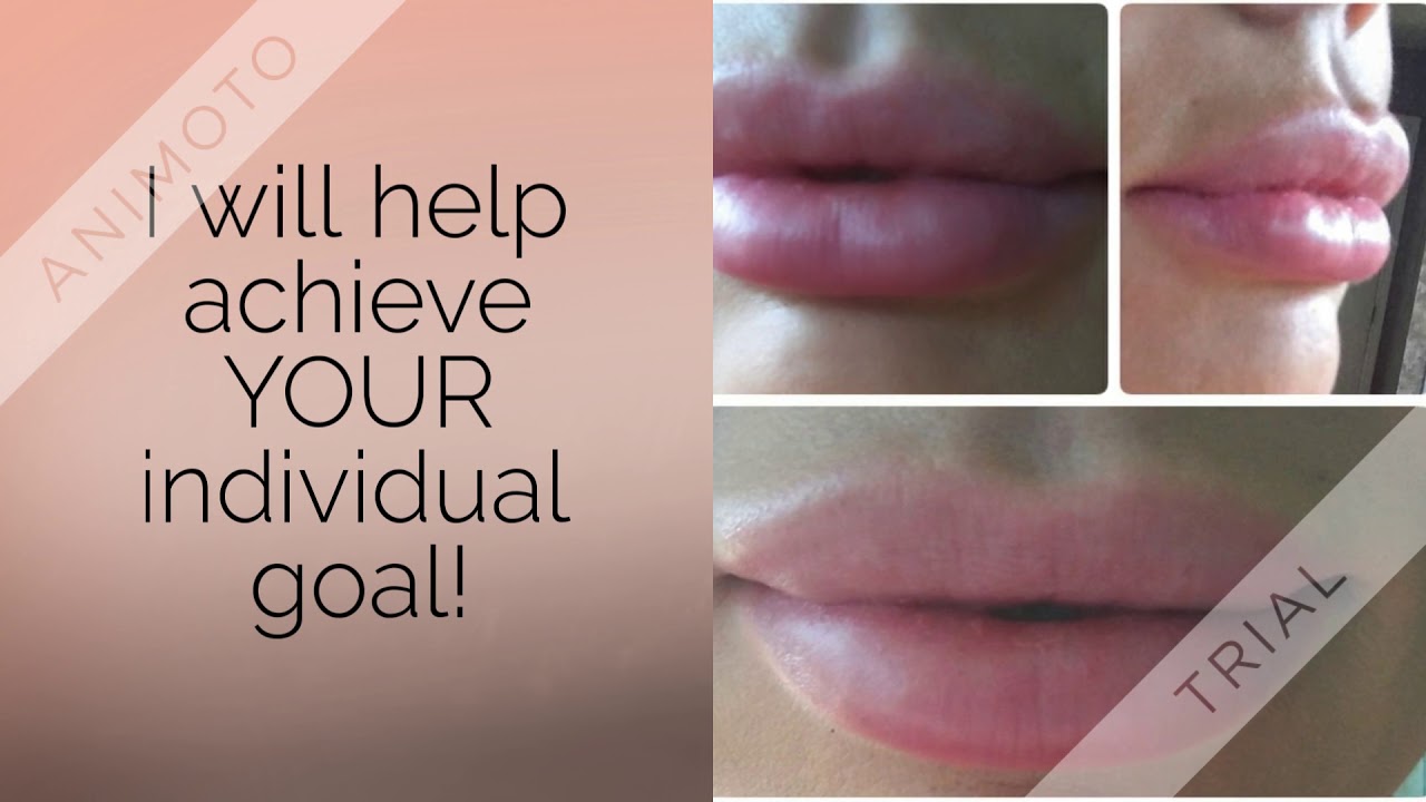 Reste Staude bekommen lip injections las vegas Lachen Liebhaber Leistung