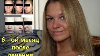 Роаккутан.После лечения.6-ой месяц./&quot;Как твои дела?&quot;