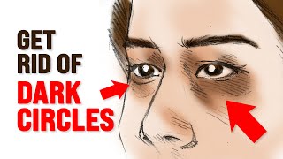 What Causes Dark Circles Under Eyes? – Dr. Berg