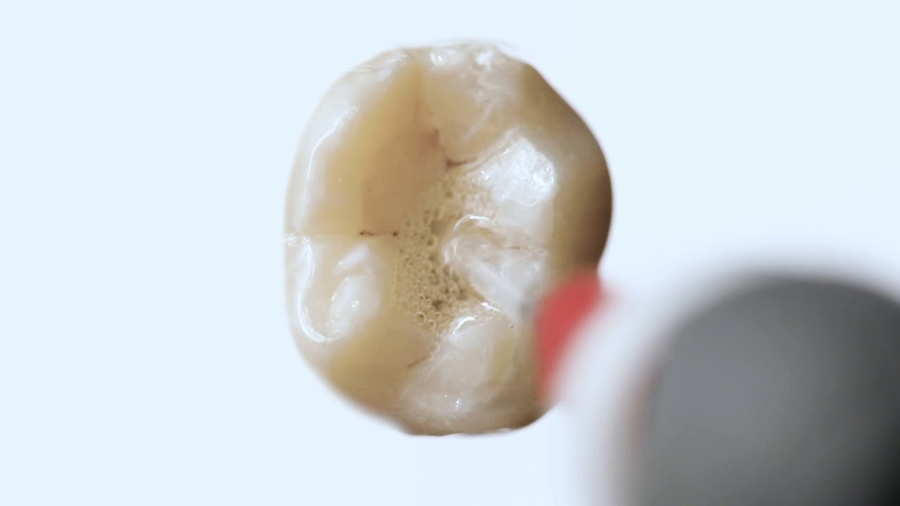 The Power of Active Irrigation in Endodontics with Dr. Mike Nimmich