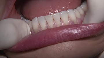 Demo C1-12 Mandibular Anterior with Deep Recession and Cervical Restorations - NEW