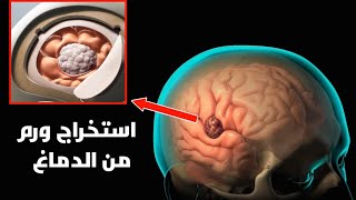 شاهد كيف يتم استخراج ورم من الدماغ|مالم تراه عينيك من قبل_Brain tumor removal
