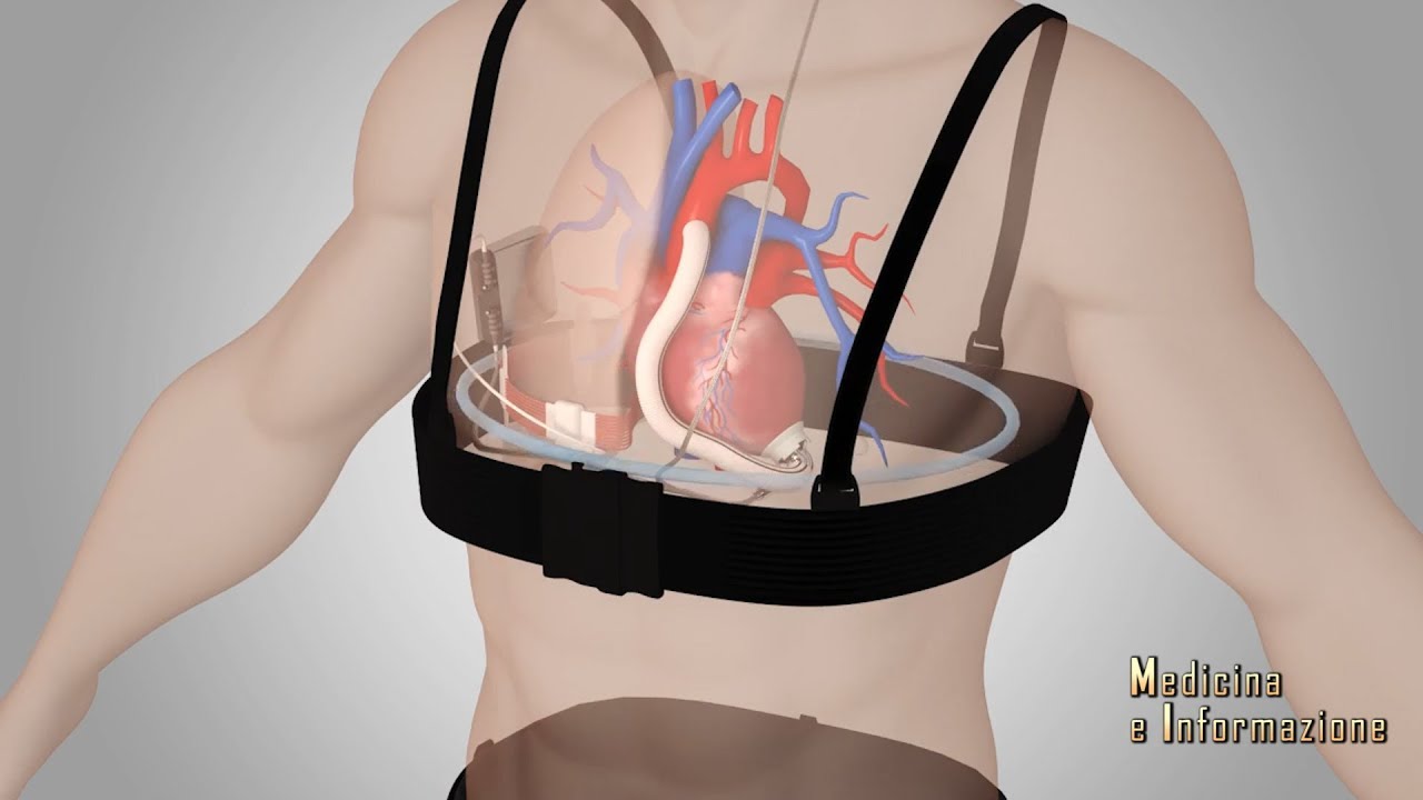 Cuore Artificiale Wireless: la rivoluzione nella cardiochirurgia