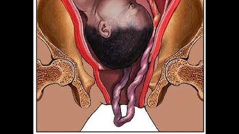 Umbilical Cord Prolapse