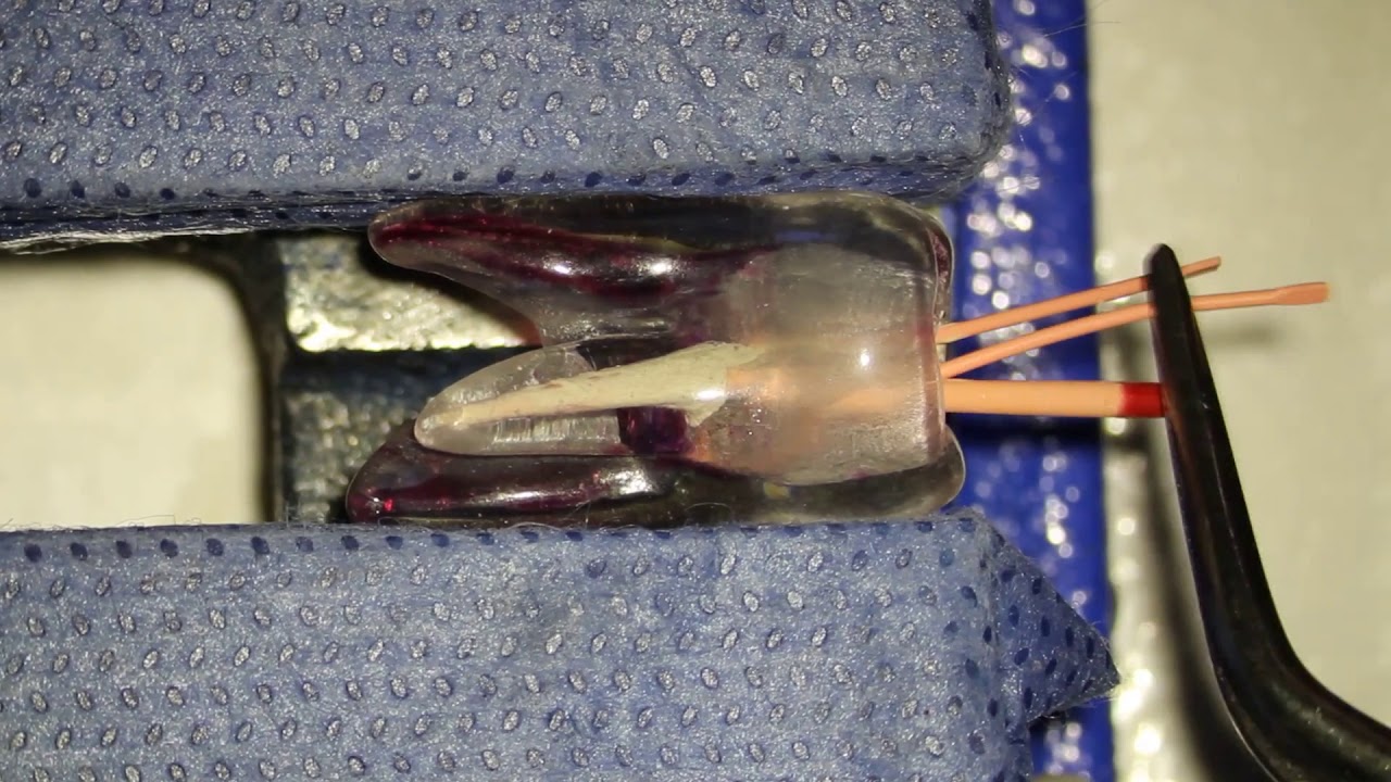 Capítulo V. Vídeo 2. Técnica de condensación lateral.