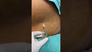 Lumbar puncture on a patient with a headache