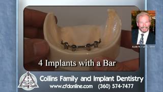 Four implants with a bar anchor a denture
