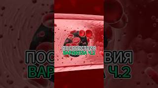ПОСЛЕДСТВИЯ ВАРИКОЗА ЧАСТЬ 2 #валеев #массаж #доктор #варикоз