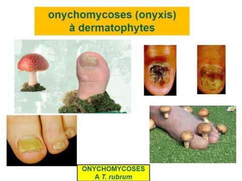 Video: Anisakidose: Symptome, Fotos, Behandlung