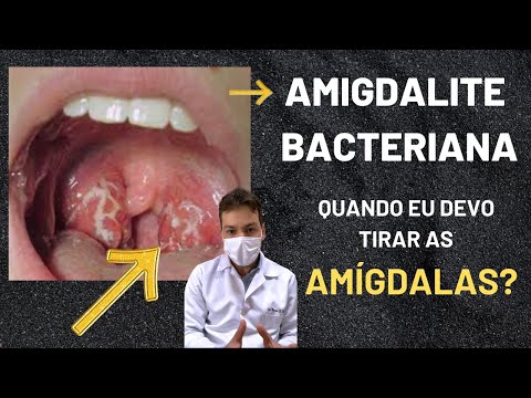 Quando diante de uma infecção de garganta eu devo remover as Amígdalas ?