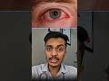 Pink Eye Alert Don T Ignore It Conjunctivitis Pinkeye Treatment Alert mp3