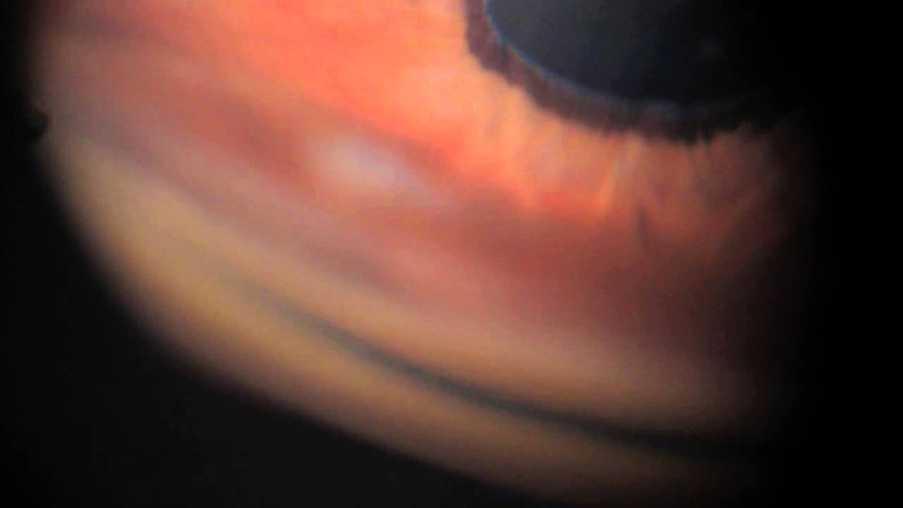 Базальная колобома радужки