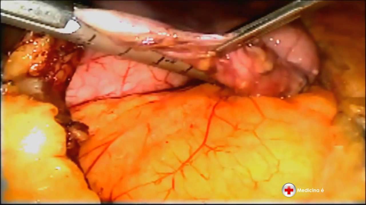 Cirurgia bariátrica, redução de estômago - YouTube
