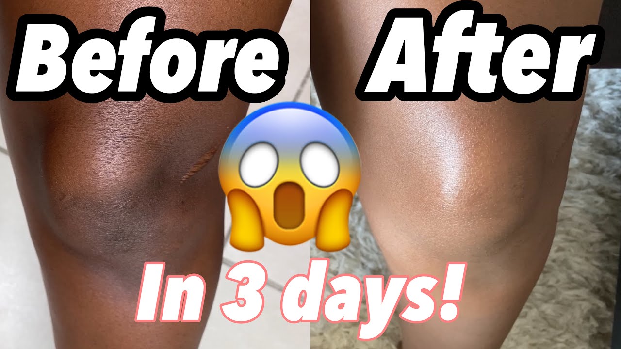 HOW TO GET RID OF DARK KNEES FAST! *natural remedy*