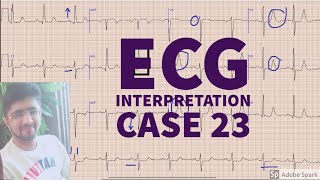 ECG made easy case 23 | EKG| ELECTROCARDIOGRAM| EDUCATIONAL VIDEO