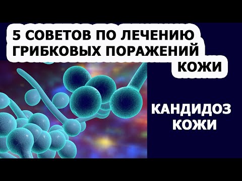 КАНДИДОЗ КОЖИ. СИМПТОМЫ КАНДИДОЗА. 5 советов ПО ЛЕЧЕНИЮ ГРИБКОВЫХ ПОРАЖЕНИЙ КОЖИ.