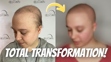 Total Transformation: Alopecia to SMP | Client Testimonial | Ink2Scalp SMP Studios