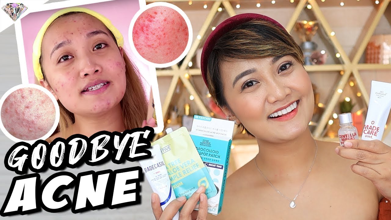 VLOGMAS DAY 4 | MGA PAMPAWALA NG TIGYAWAT AT ACNE MARKS | WHAT IS ACNE | ACNE DEPRESSION | MAE LAYUG