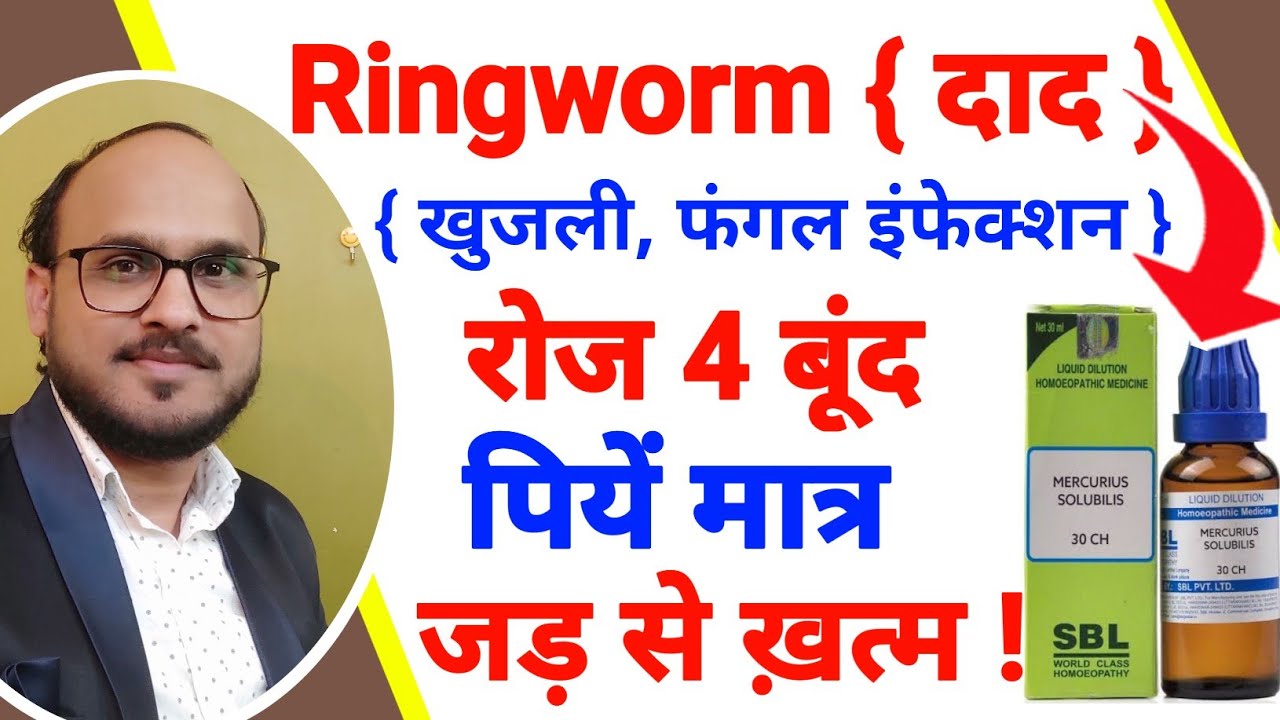 ringworm ! Homeopathic medicine for ringworm ? ringworm treatment / दाद