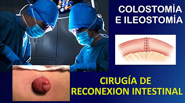 ¿Es una colostomía una operación seria?