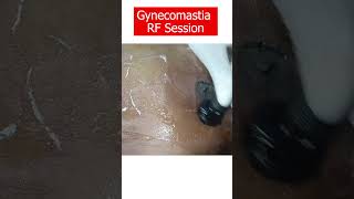 Get Rid of Male Breast | Gynecomastia result after dressing removal