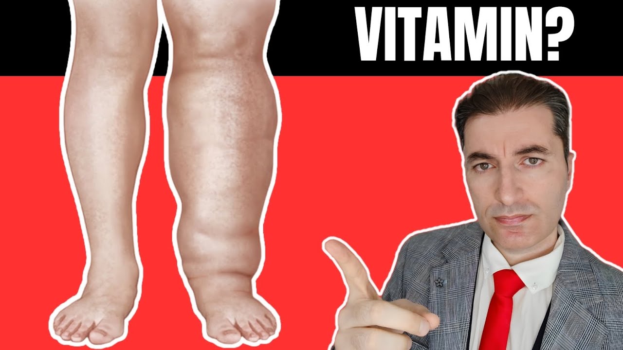 Koji je najvažniji VITAMIN za uklanjanje OTEKLINA NOGU,RUKU, ZGLOBOVA ...?