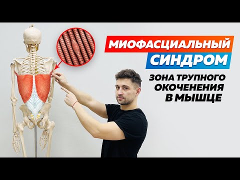 Миофасциальный синдром. Что такое МФС?