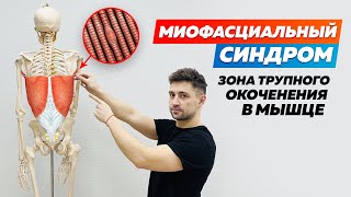 Миофасциальный синдром. Что такое МФС?