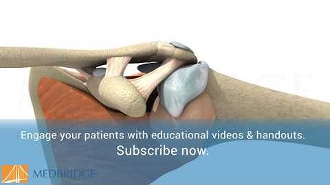 Shoulder Impingement Video - Patient Education | MedBridge