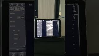Wireless Phone Ultrasound Probe DW-X1 hands-on video on MSK