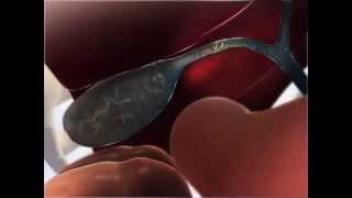 Learn@Visible Body - Gallstones