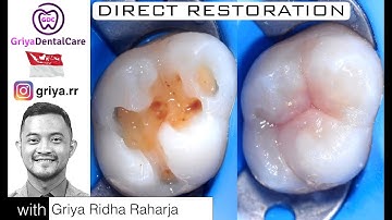 Direct Restoration Composite Class 1 Posterior / Penambalan gigi dengan Komposit Kelas 1