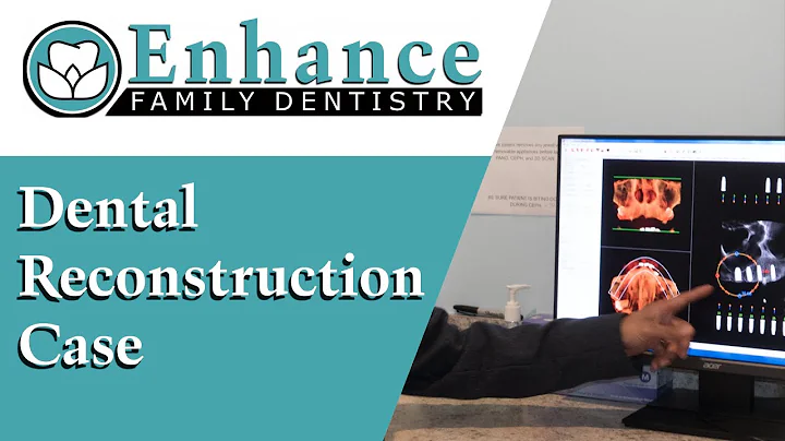 Dental Reconstruction Case | Dr. Paresh Shrimankar...