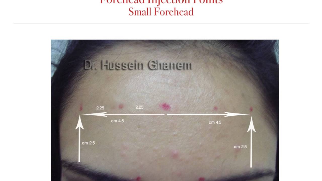 Botox safe Geometric injection technique - YouTube