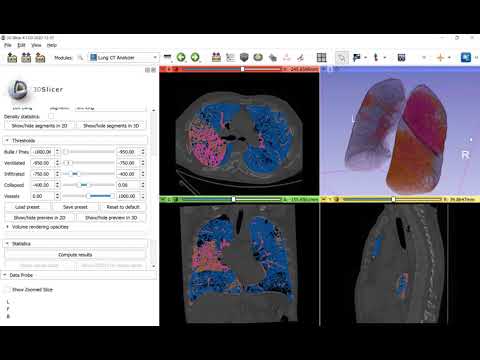 Automated lung CT segmentation and analysis for COVID-19 assessment