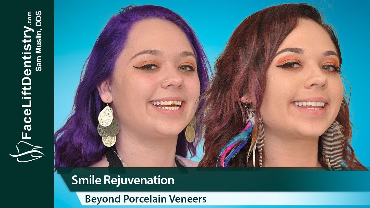 Non-Destructive Smile Makeover veneers vs crowns