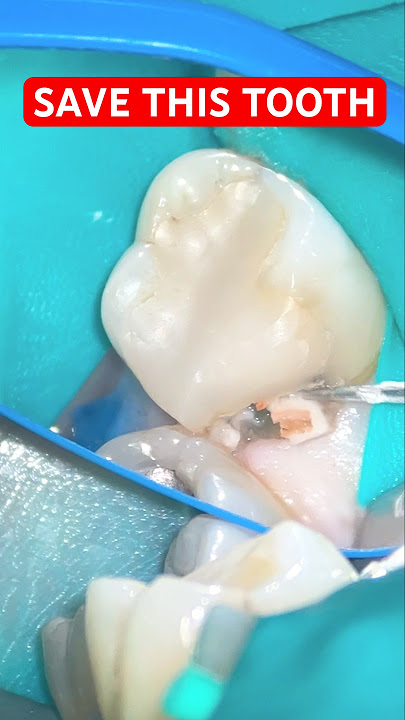 From Pain to Perfection 💚 Root Canal   E.max Overlay in 60 Seconds