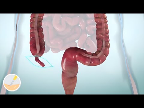 Laparoscopic & Open Appendectomy procedures: Medical animation