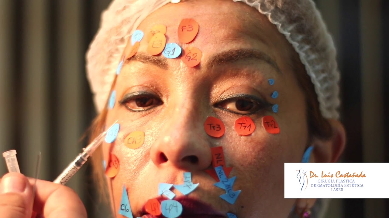 Enfoque FCR. Inicio y planos de colocación del ácido hialúronico MD CODES ™️