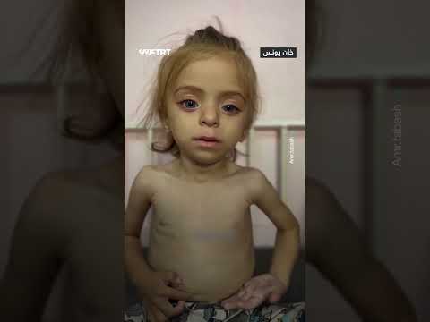 غزة: المجاعة تهدد حياة الطفلة سيلين وادي (سندريلا غزة)